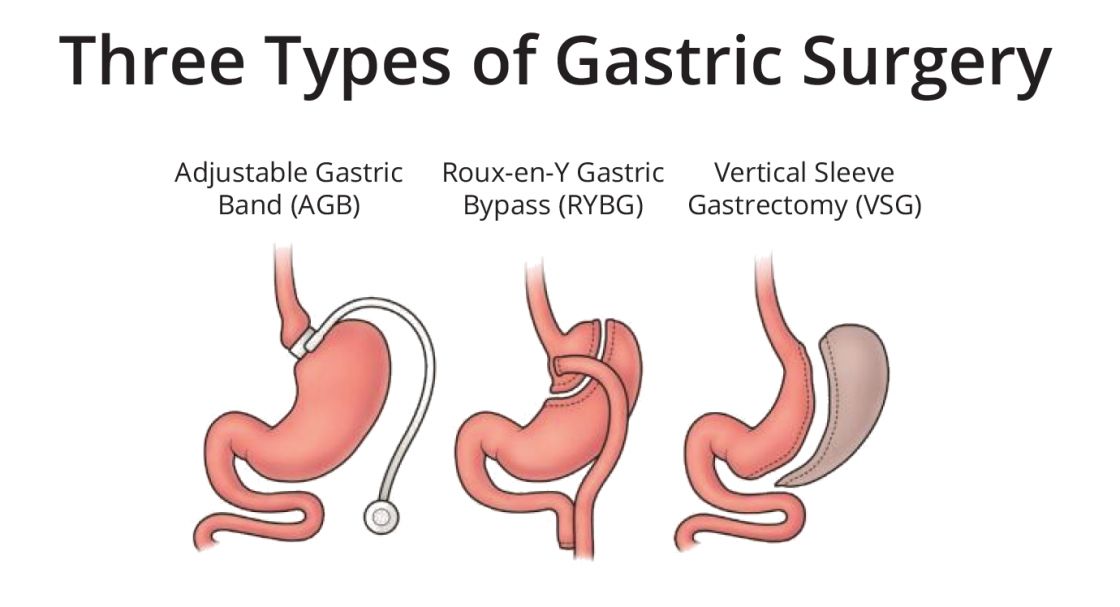 Types of Gastric Surgery