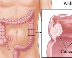 Colorectal Cancer – What Are The Risk Factors?